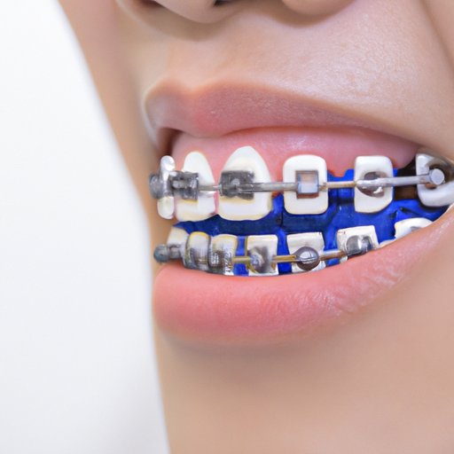 The Benefits of Healthy Blue Cover Braces