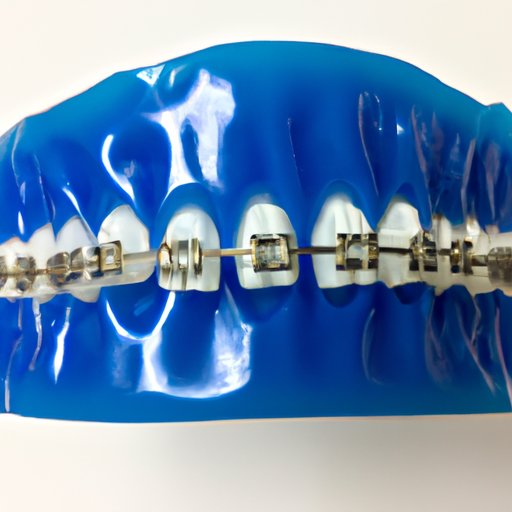 A Guide to Choosing the Right Healthy Blue Cover Braces