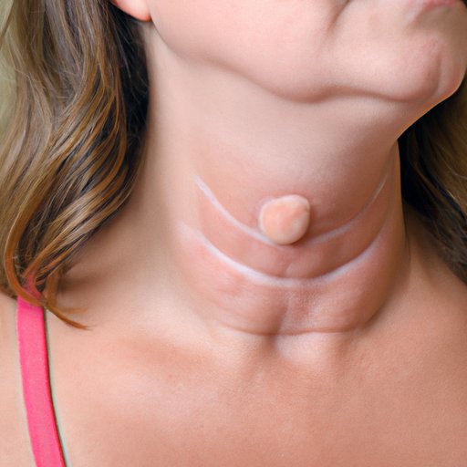 Home Remedies for Swollen Lymph Nodes