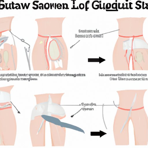 An Overview of How a Gastric Sleeve Surgery Works
